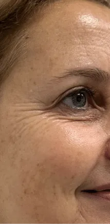 Contorno de ojos antes del tratamiento de fisioestética con tecarterapia en LSP Rivas