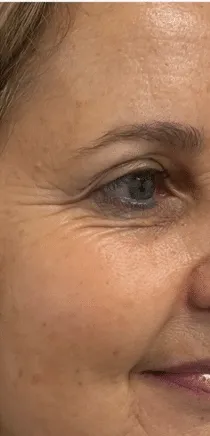 Contorno de ojos después del tratamiento de fisioestética con tecarterapia en LSP Rivas